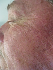 RJ#6 08-05-11 (7 weeks post MMS)